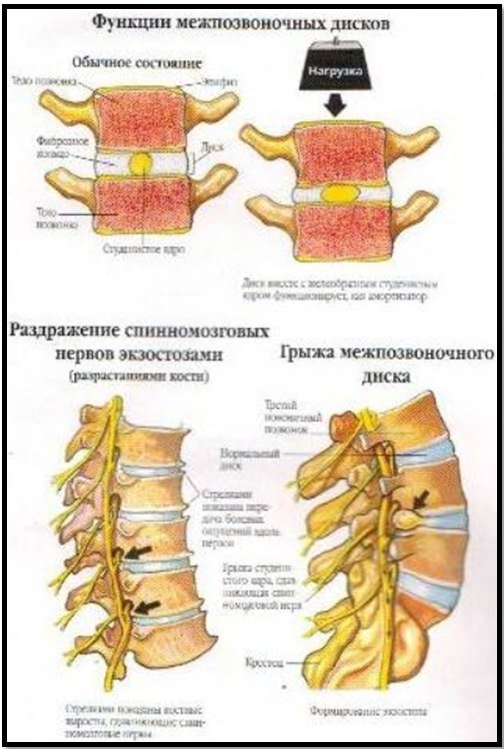 Гимнастика при грыже диска позвоночника. Протрузия поясничного отдела позвоночника гимнастика. Гимнастика для межпозвоночной грыжи поясничного отдела. Гимнастика при протрузии поясничного отдела позвоночника. Гимнастика от протрузии межпозвонковых дисков.